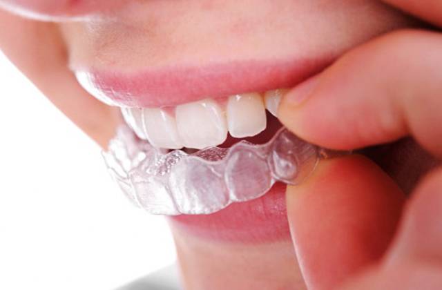  Tẩy trắng răng đeo máng tại nhà đơn giản hiệu quả bất ngờ