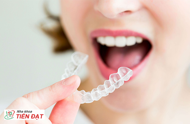Chỉnh nha tháo lắp là gì? Lợi ích và bất lợi của chỉnh nha tháo lắp