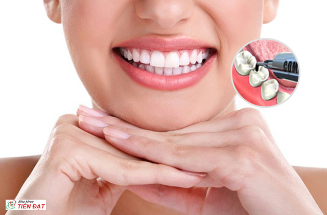 Trám răng composite có bền không? - Nha khoa Tiến Đạt 