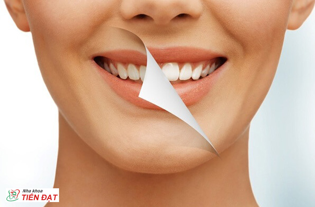 Chi phí làm trắng răng tại nha khoa giá bao nhiêu?