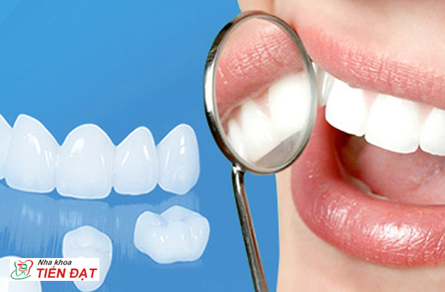 Có mấy loại răng sứ? Nên bọc răng sứ loại nào tốt nhất